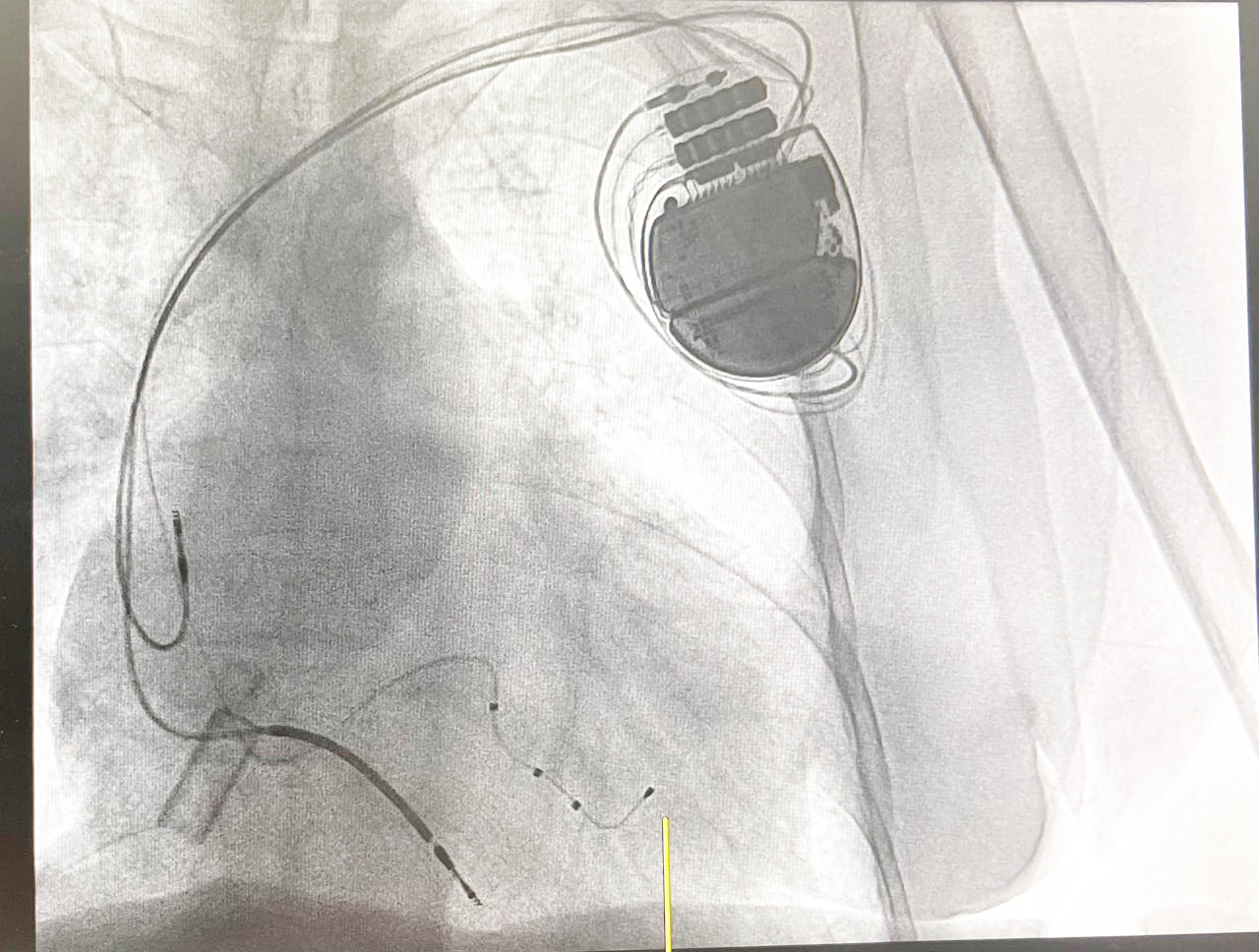 AIIMS Jammu achieves another milestone in Cardiac Care with first CRT-D implantation