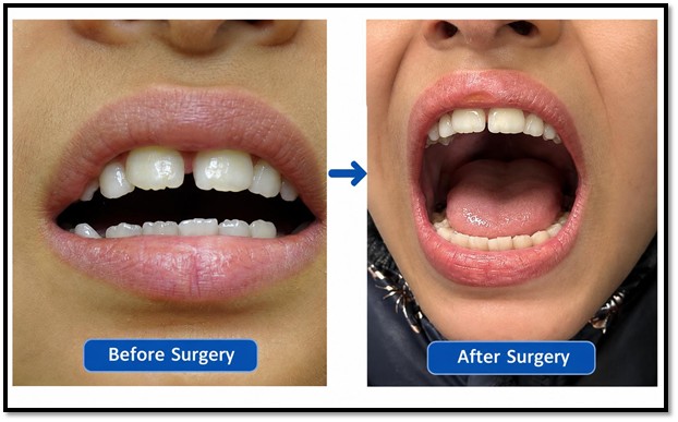 Seven-year-old girl regains jaw movement after complex surgery at AIIMS Jammu Seven-year-old girl regains jaw movement after complex surgery at AIIMS Jammu